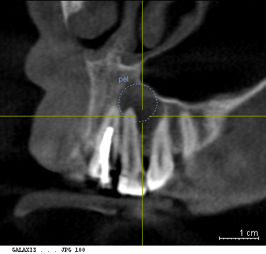 歯科用CTによる 根尖病巣検査(細菌感染検査)